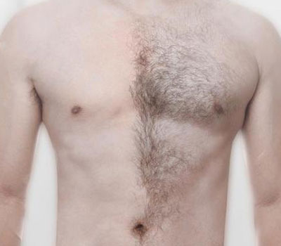 body-hair-transplant