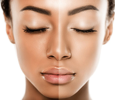 color-improvement-with-lasers