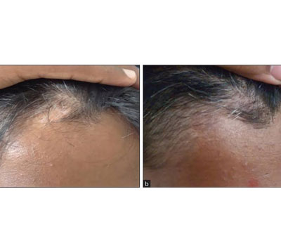 follicular-transplant