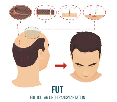 follicular-unit-transplantation