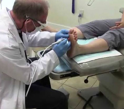 laser-surgery-for-warts