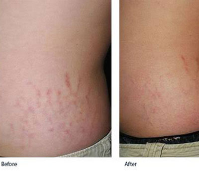 laser-therapy-for-stretch-marks