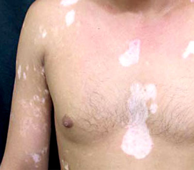 melanocyte-transplantation-surgery