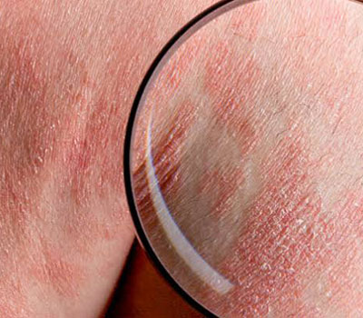 psoriasis