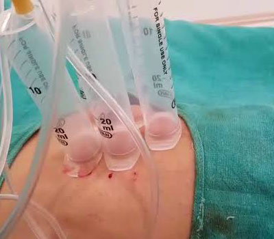 suction-blister-grafts