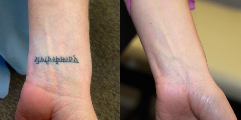 tattoo-removal