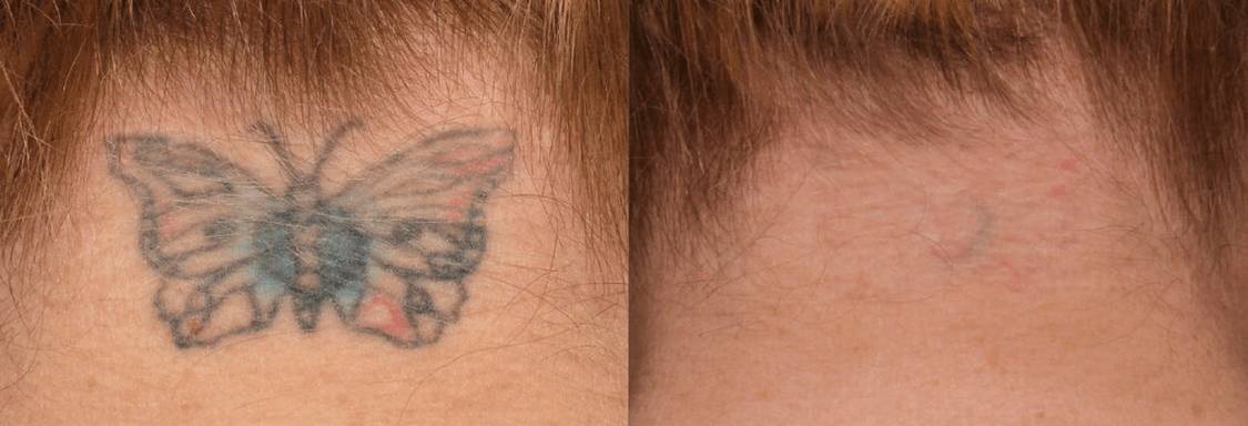 tattoo-removal1