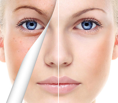 yellow peel treatment